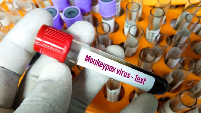 Test sanguin variole du singe, monkeypox